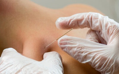 Dry Needling in Physical Therapy: What Is It and How Does It Work?