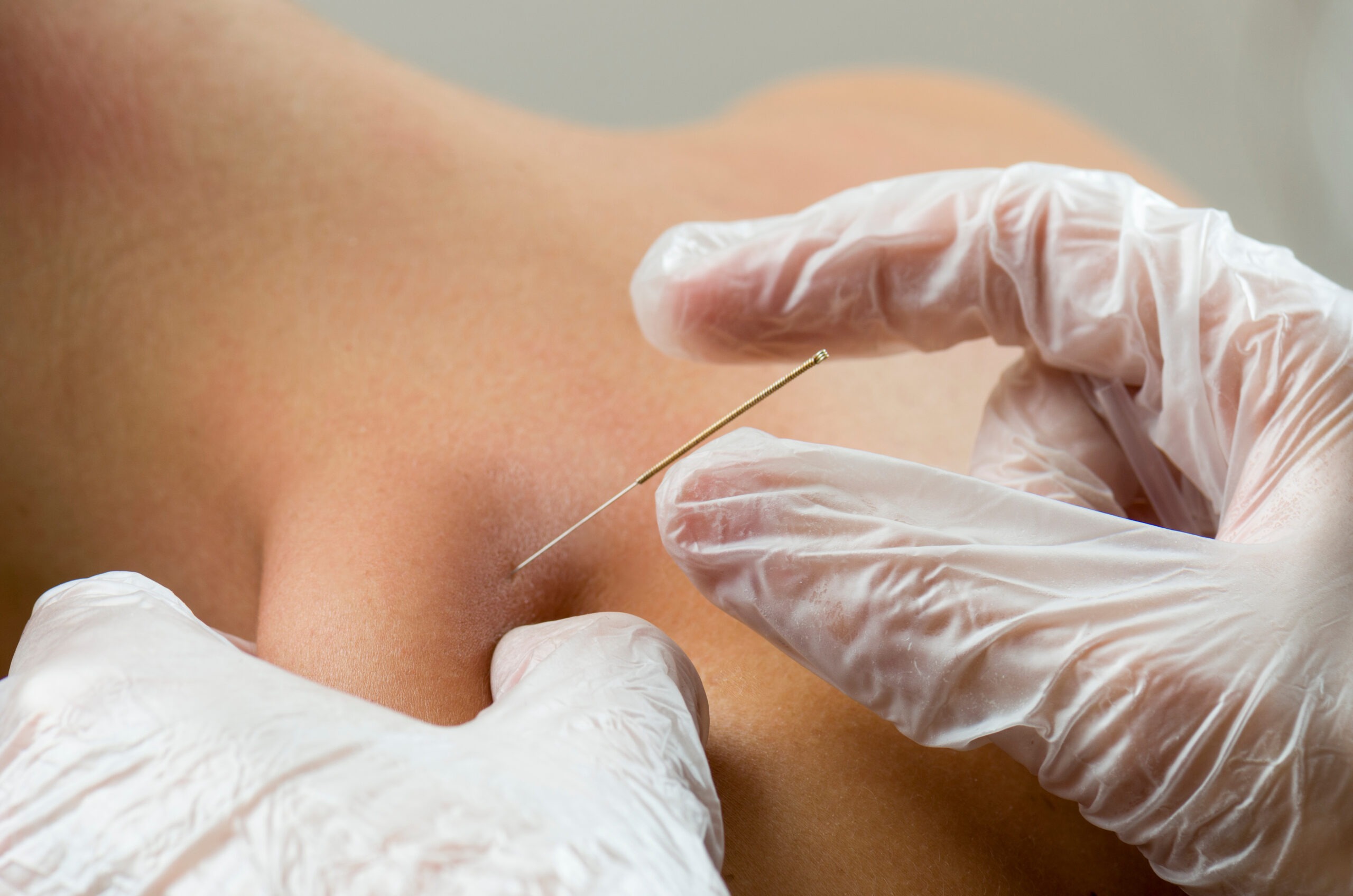 Closeup of a needle and hands of physical therapist doing a dry needling treatment on someones upper back.