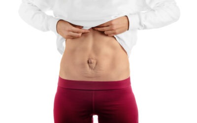 How to Tell If You Have Diastasis Recti
