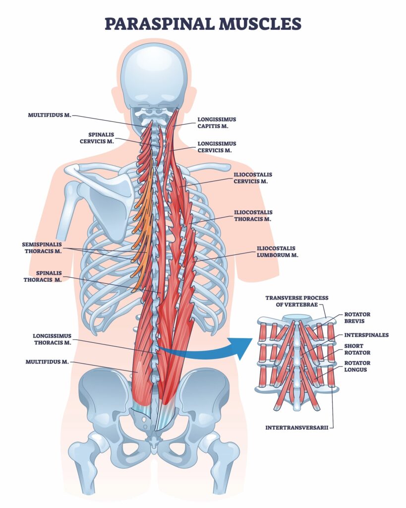 Paraspinal muscles, including the multifidius